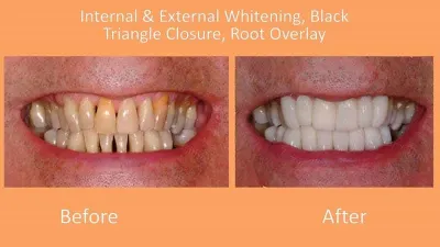 bioclear dentist lakewood ranch before after root overlay