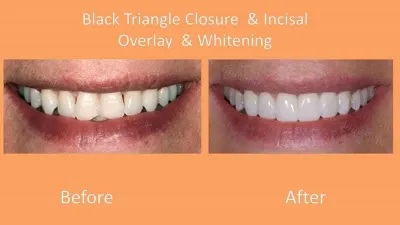 bioclear dentist lakewood ranch before after black triangles