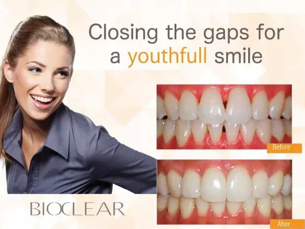 bioclear veneers bioclear dentist Lakewood Ranch method