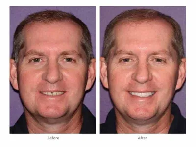 bioclear dentist lakewood ranch before after men