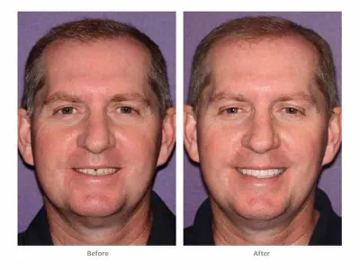 Bioclear Matrix Florida dentist lakewood ranch before after men