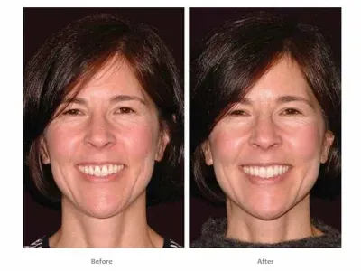 bioclear dentist lakewood ranch before after women