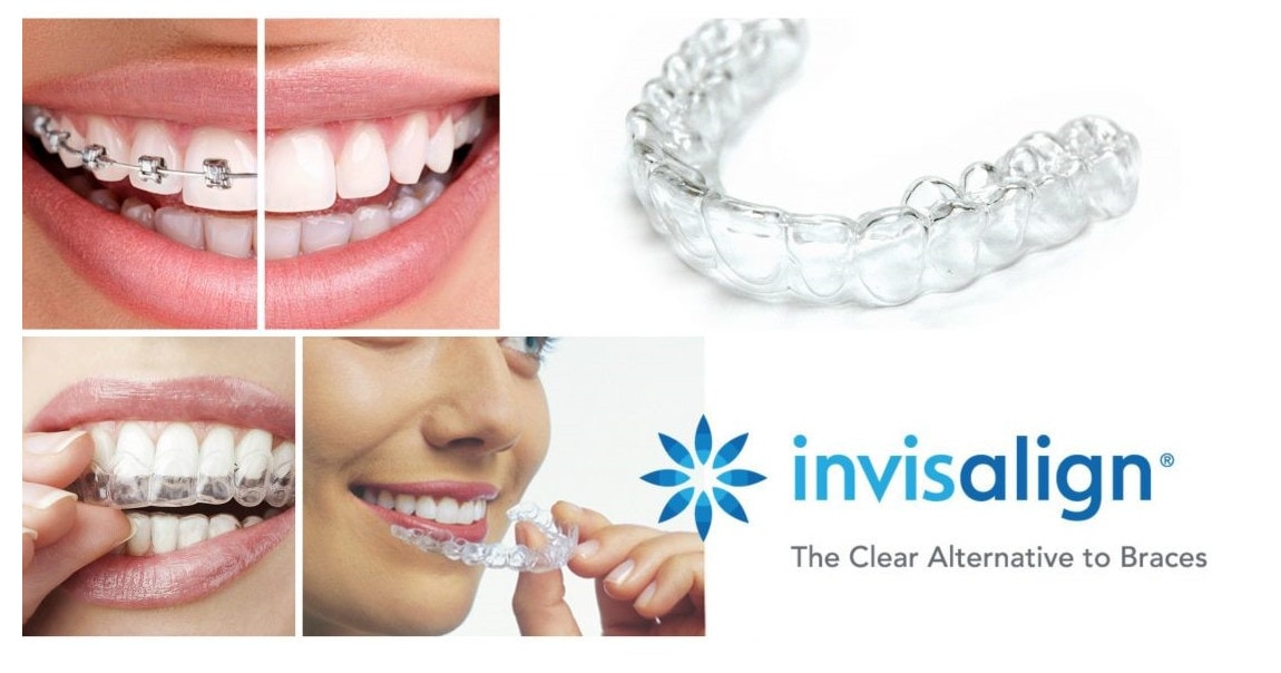invisalign Lakewood Ranch clear braces