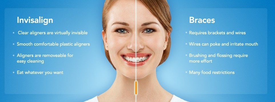 Lakewood Ranch Invisalign clear braces before after