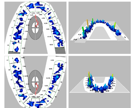 lakewood ranch tekscan dentist T-scan tscan technology report bite analysis